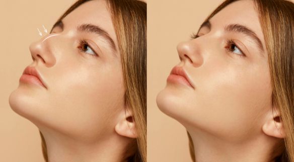 Rinoplastia en Sevilla