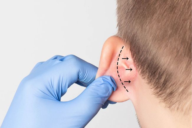 Cirugía plástica 9 Otoplastia en Sevilla